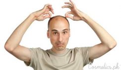 Top 5 Home Remedies For Baldness