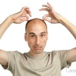 Top 5 Home Remedies For Baldness