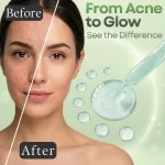 Forever Bloom Anti Acne Skin Serum | 30ml - Image 5